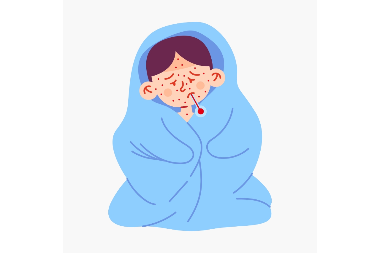 Dinkes Kota Cimahi Tingkatkan Kewaspadaan Campak